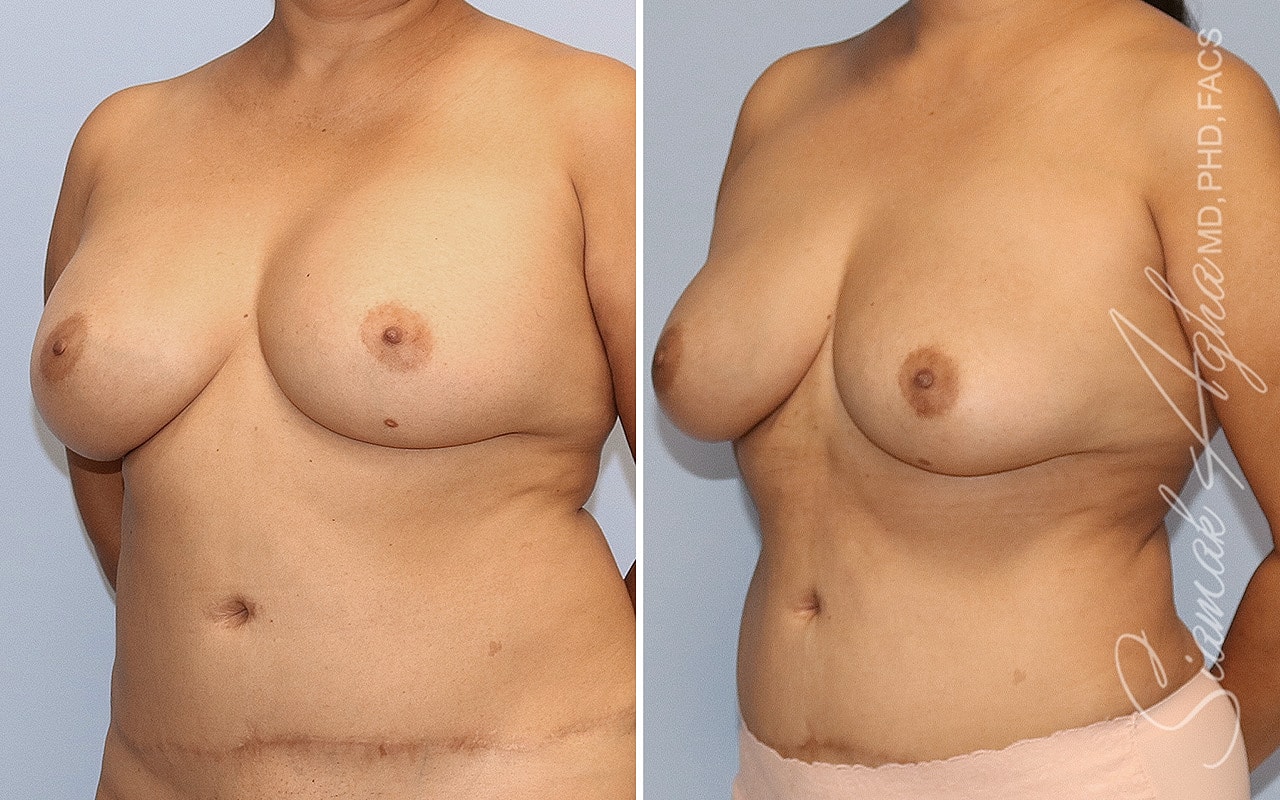 Breast Implant Removal Before & After