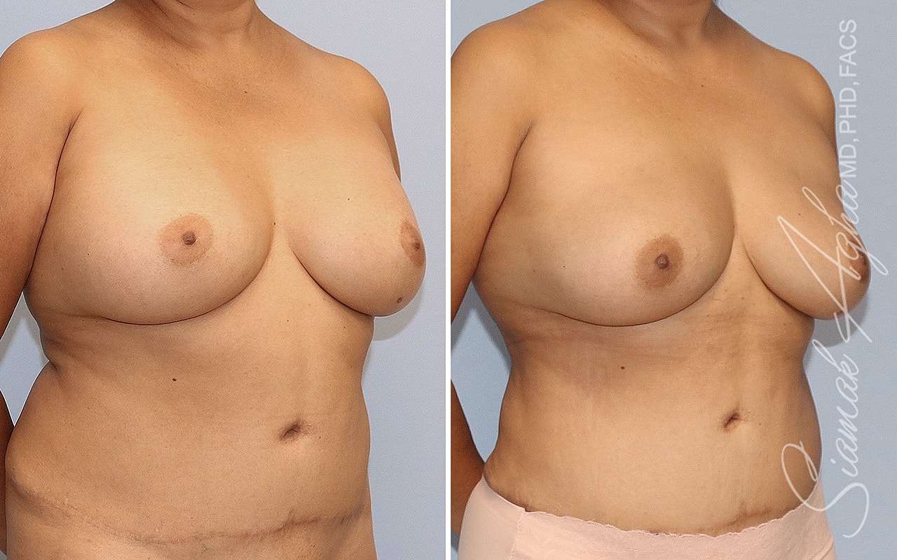 Breast Implant Removal Before & After