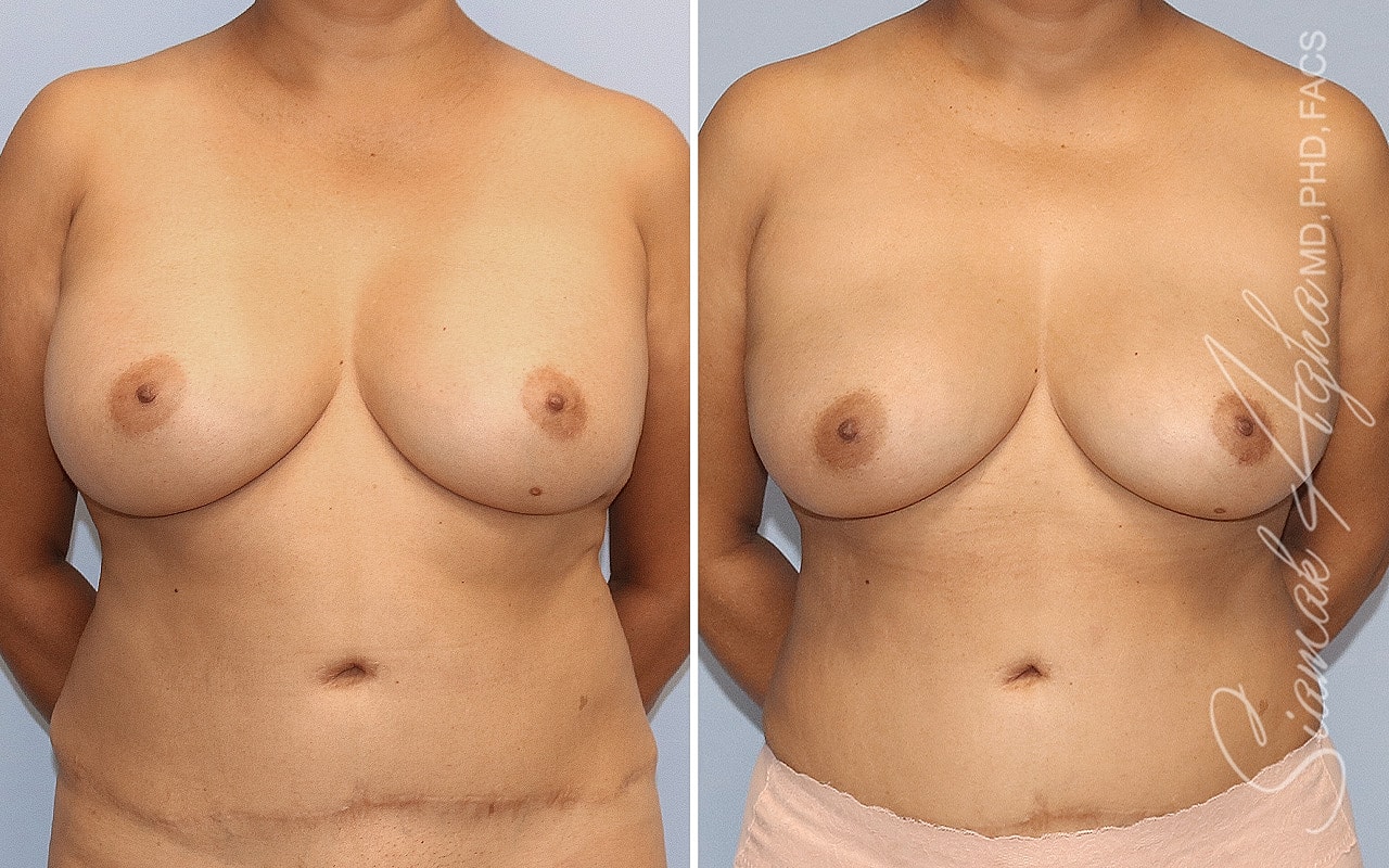 Breast Implant Removal Before & After
