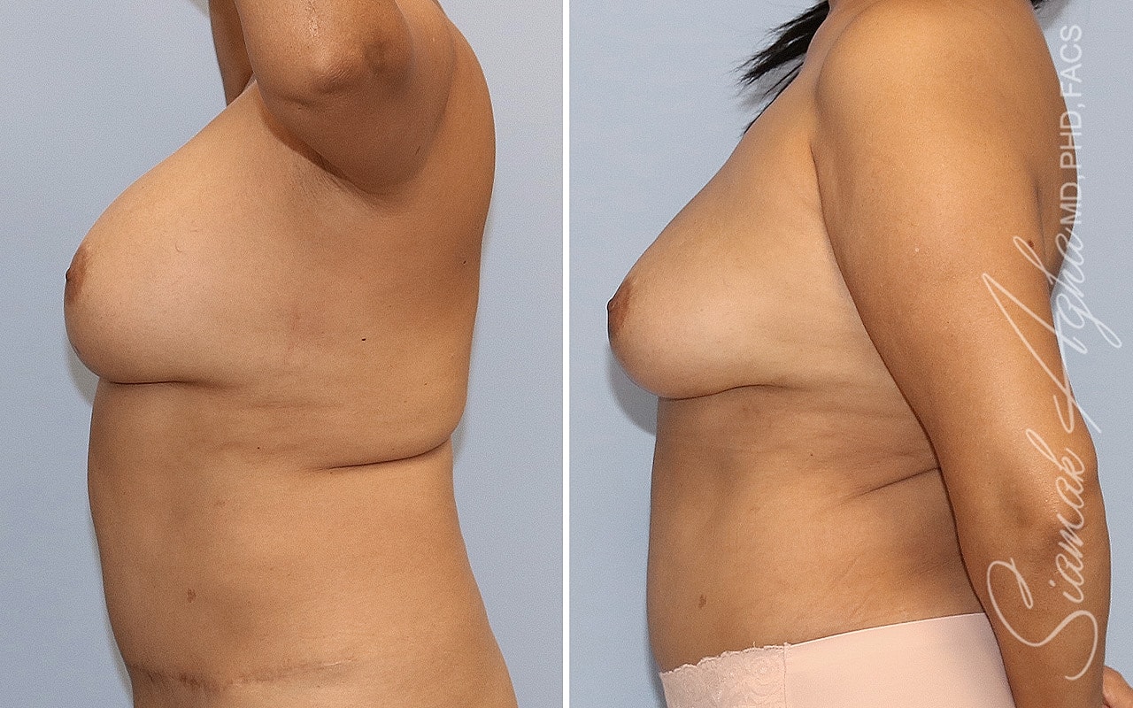Breast Implant Removal Before & After