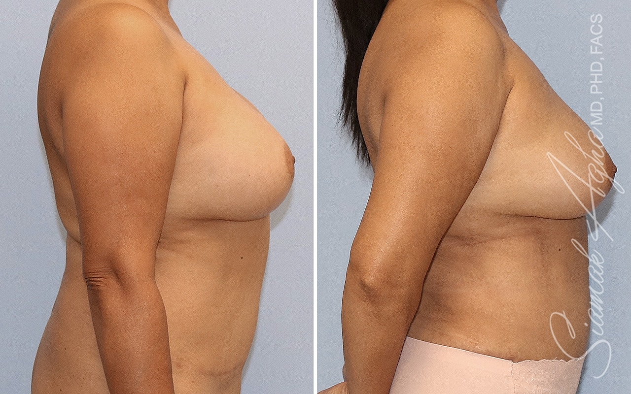 Breast Implant Removal Before & After