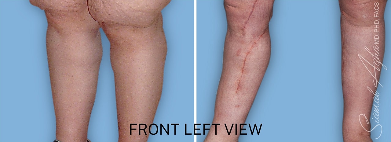 Before and after leg view comparison image