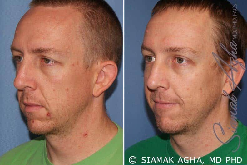 Otoplasty Before & After