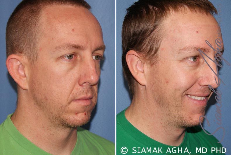 Otoplasty Before & After