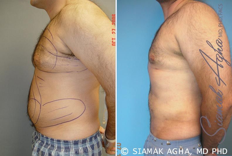Male Breast Reduction Before & After