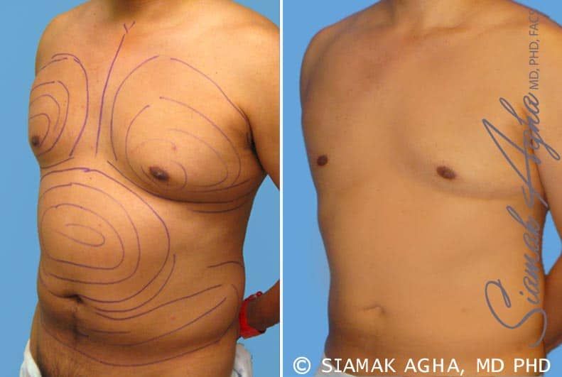 Male Breast Reduction Before & After