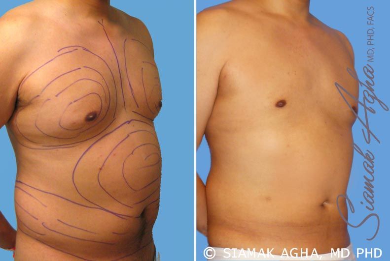 Male Breast Reduction Before & After