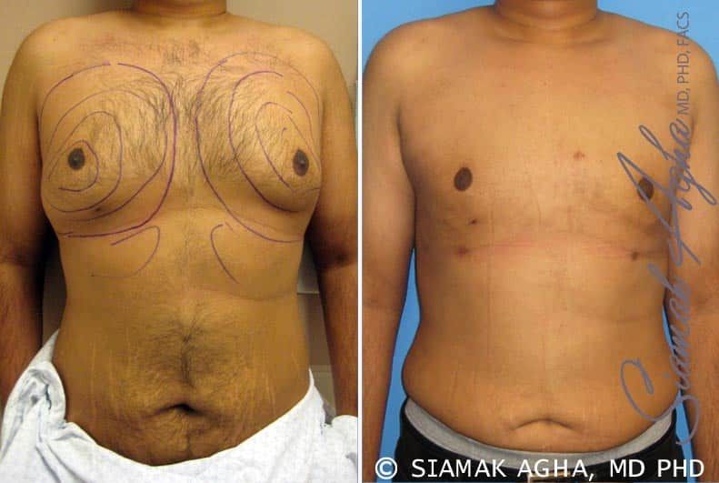 Male Breast Reduction Before & After