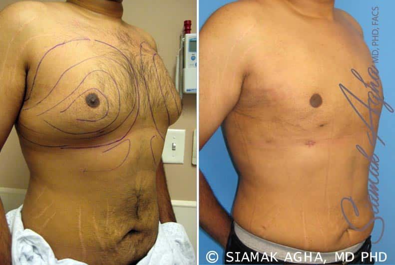Male Breast Reduction Before & After