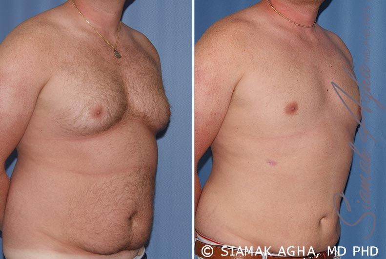 Male Breast Reduction Before & After