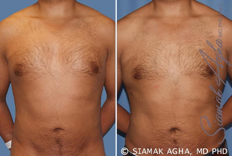Male Breast Reduction Before & After