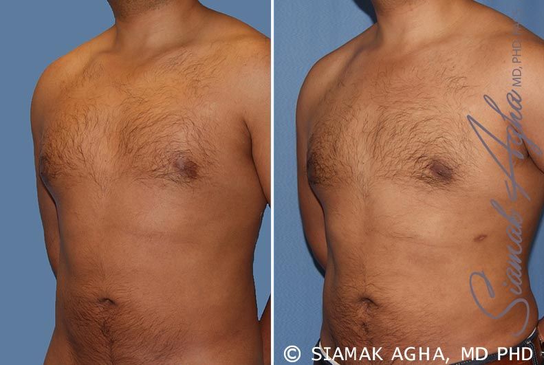 Male Breast Reduction Before & After