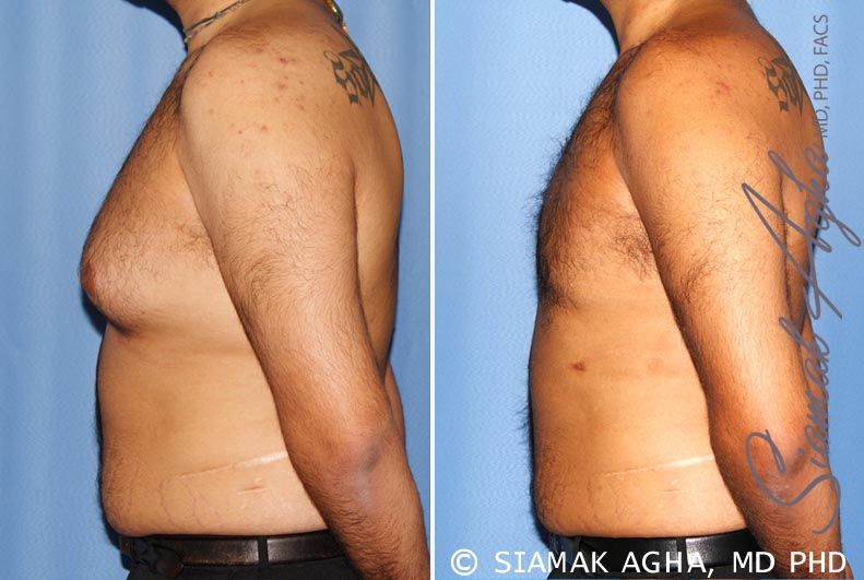 Male Breast Reduction Before & After
