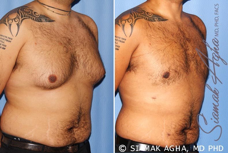 Male Breast Reduction Before & After