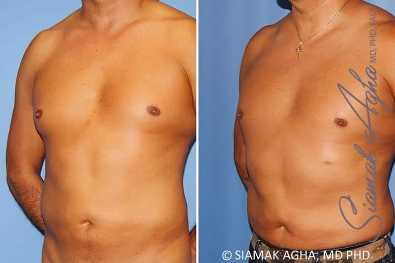 Male Breast Reduction Before & After