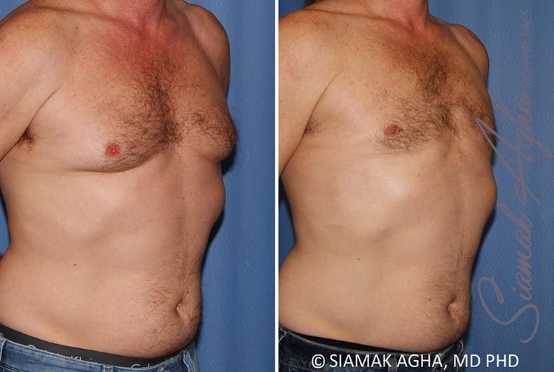 Male Breast Reduction Before & After