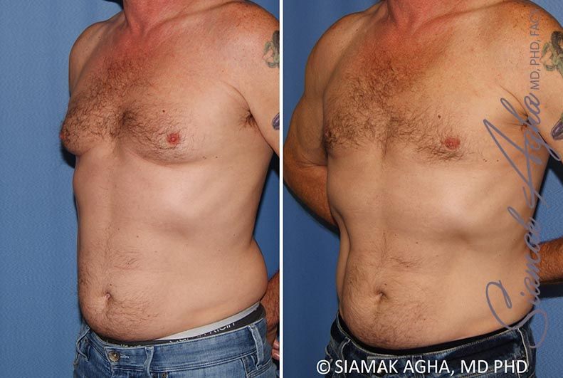 Male Breast Reduction Before & After