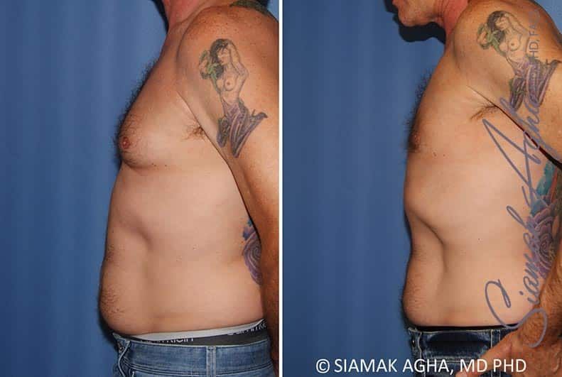 Male Breast Reduction Before & After