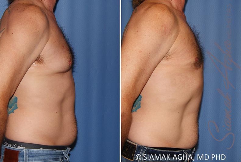 Male Breast Reduction Before & After