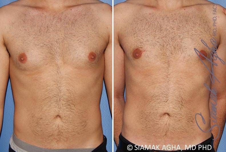 Male Breast Reduction Before & After