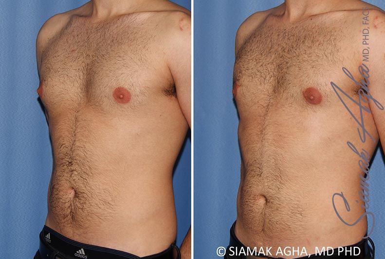 Male Breast Reduction Before & After