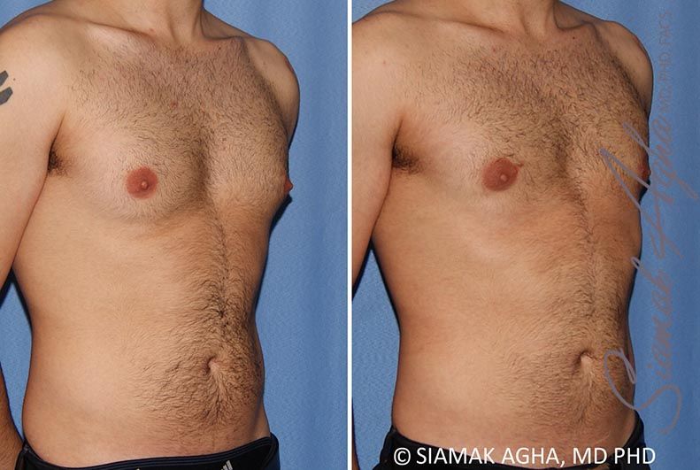 Male Breast Reduction Before & After