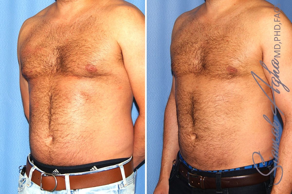 Male Breast Reduction Before & After