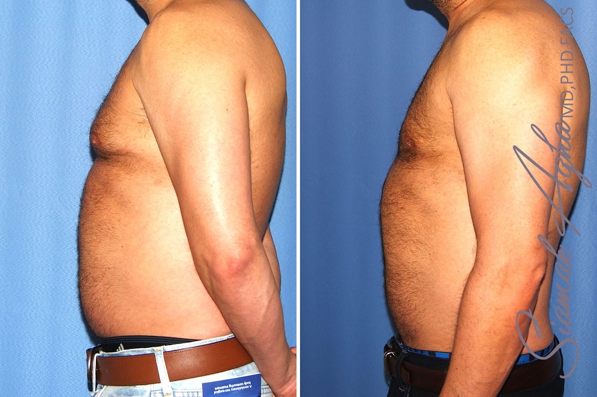 Male Breast Reduction Before & After