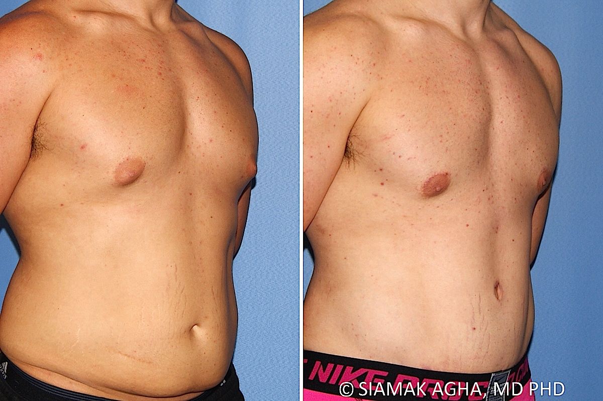 Male Breast Reduction Before & After