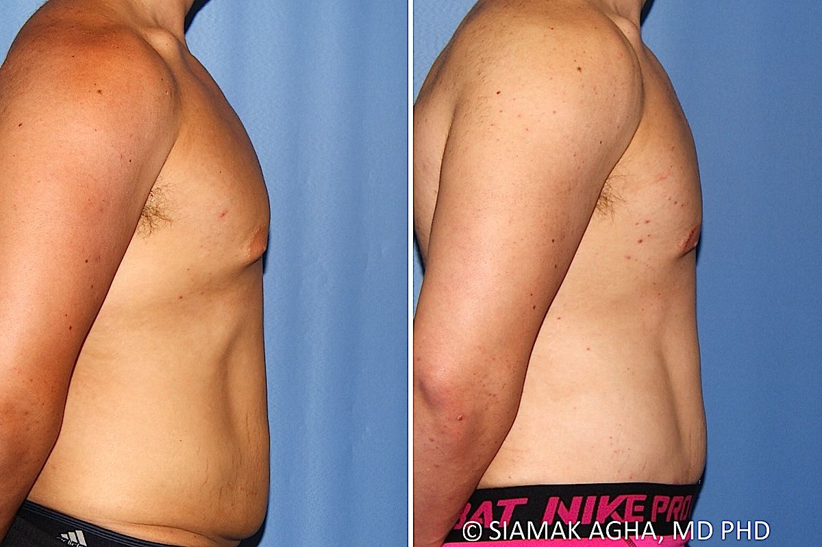 Male Breast Reduction Before & After