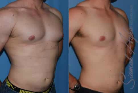 Male Breast Reduction Before & After