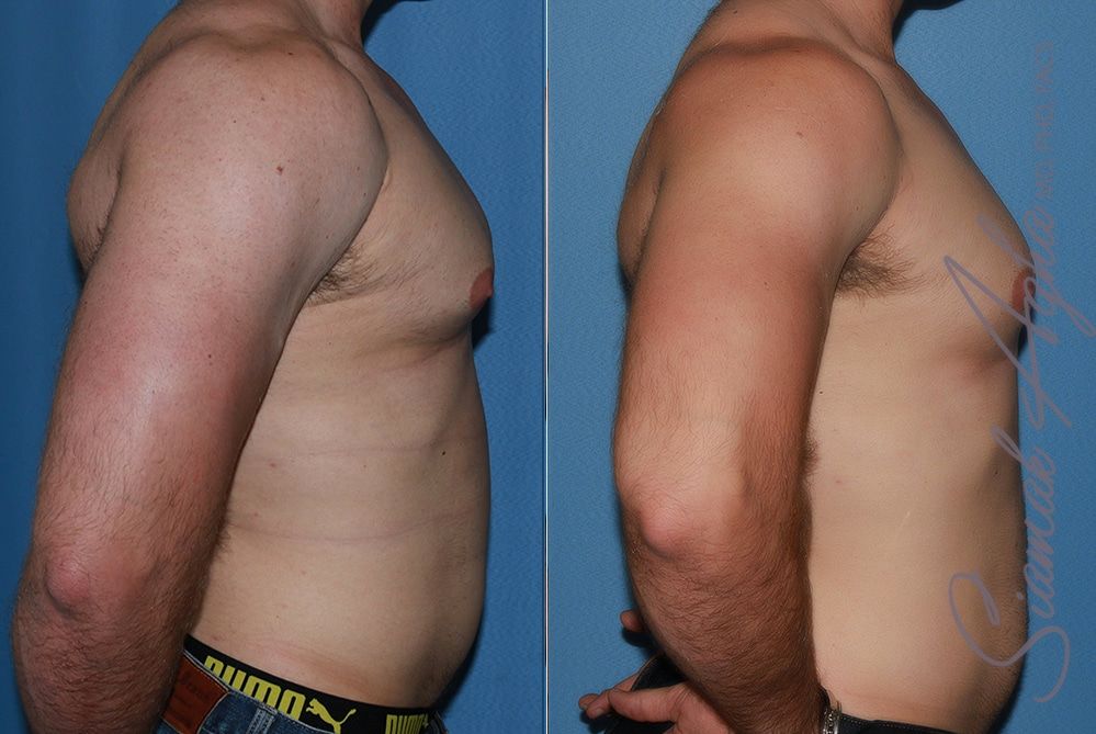 Male Breast Reduction Before & After