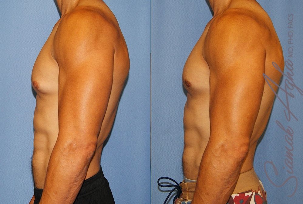 Male Breast Reduction Before & After