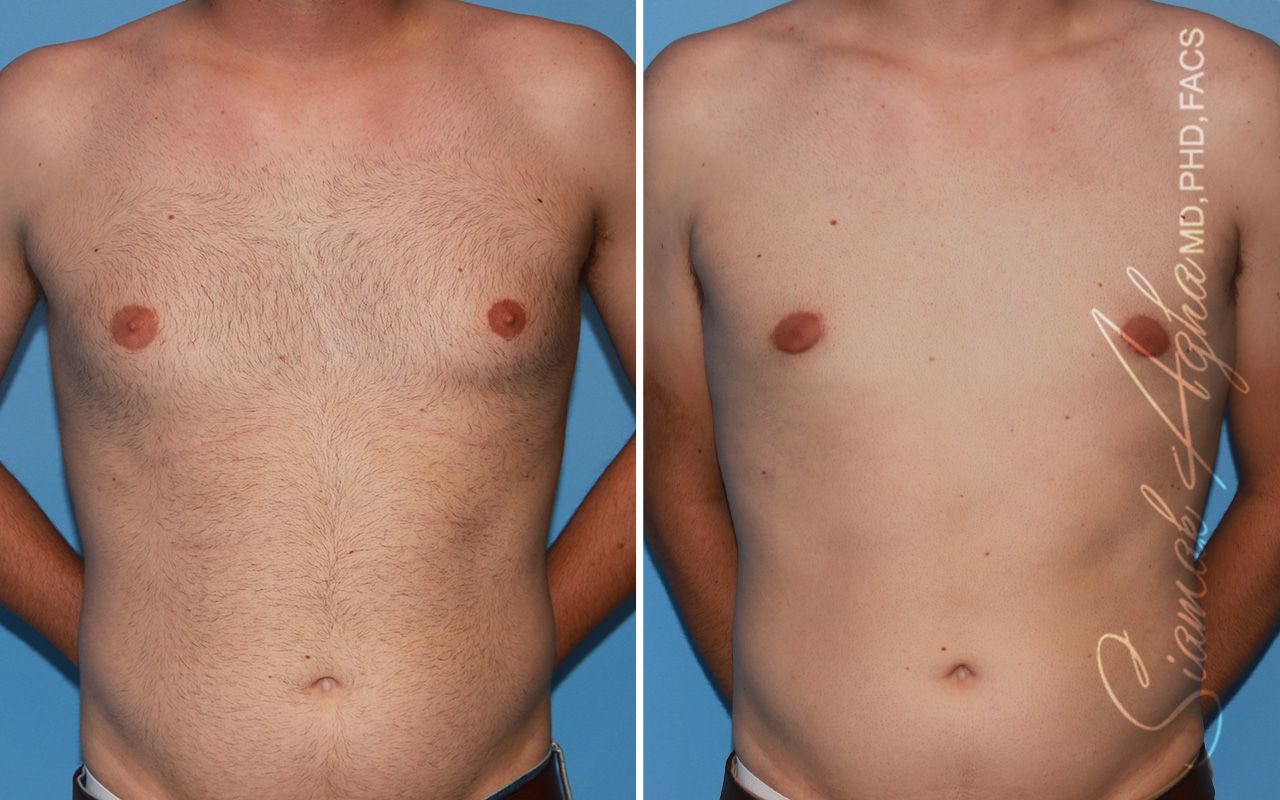 Male Breast Reduction Before & After