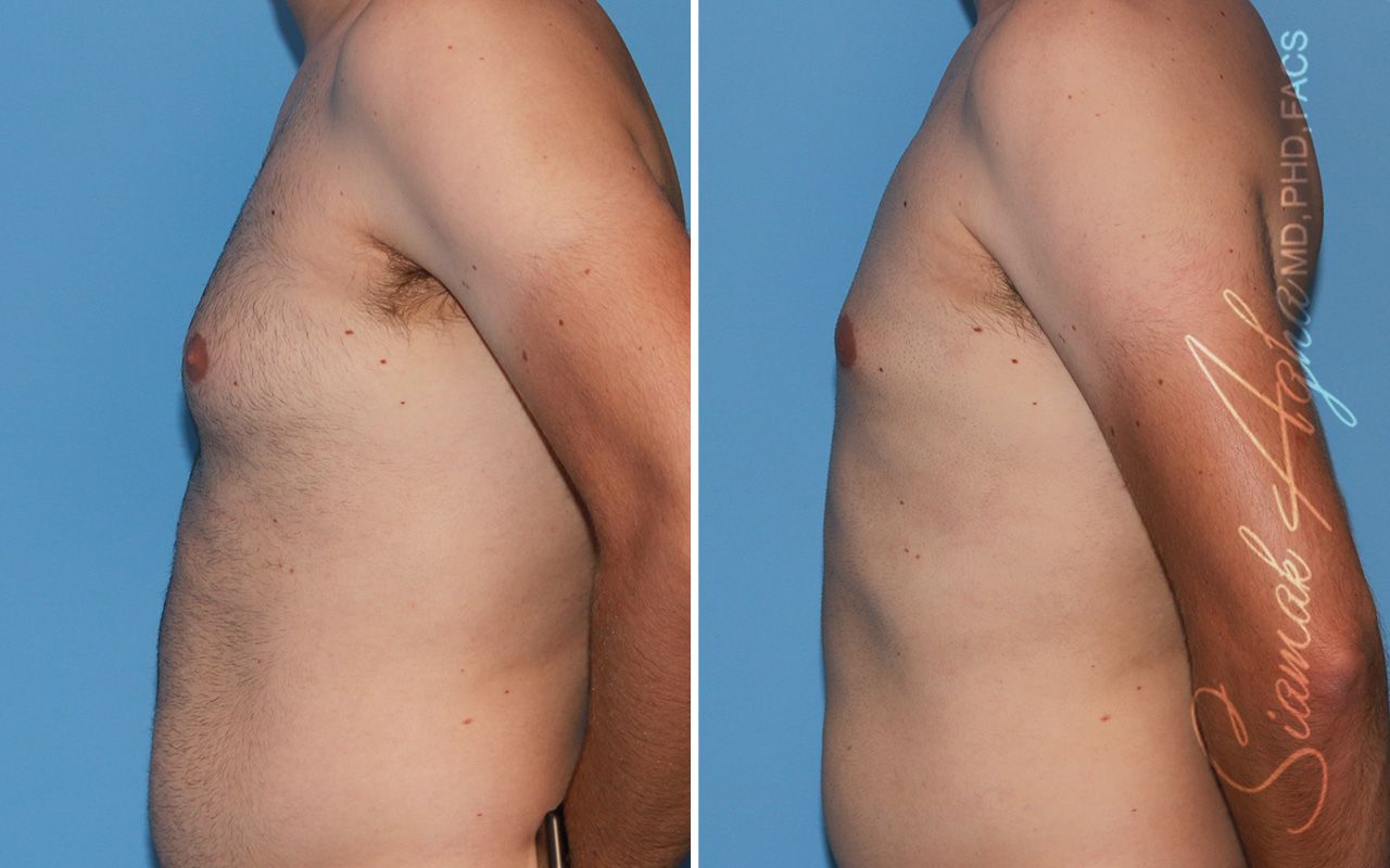 Male Breast Reduction Before & After