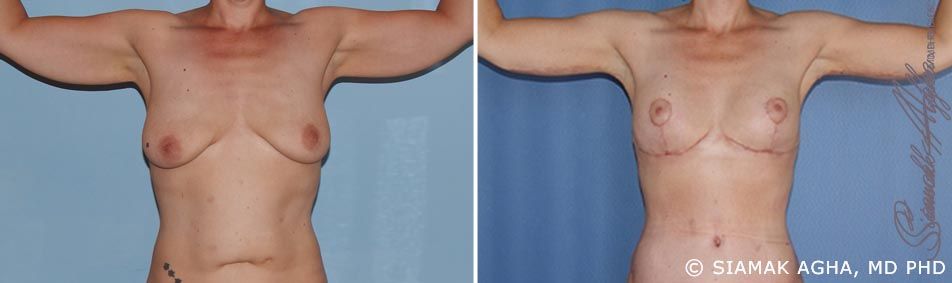 Arm Lift Before & After