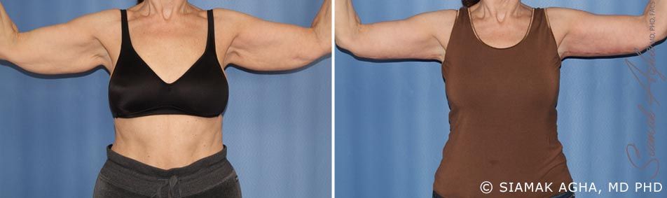 Arm Lift Before & After