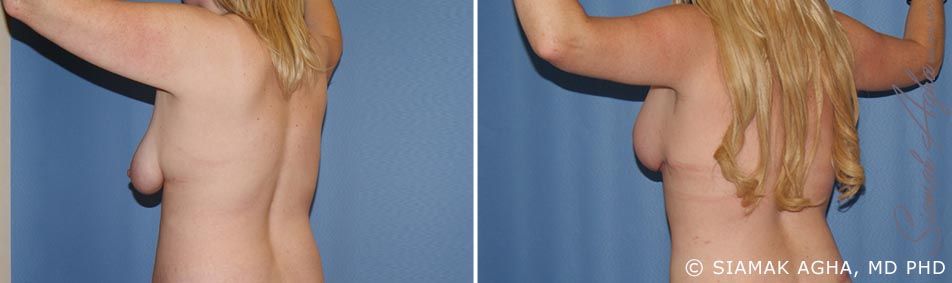 Arm Lift Before & After