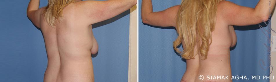 Arm Lift Before & After