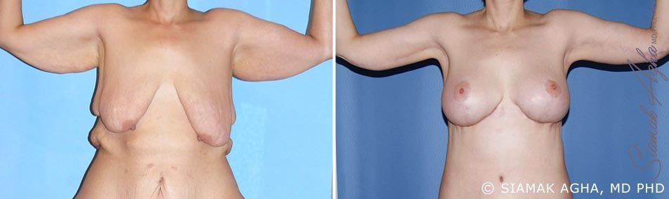 Arm Lift Before & After