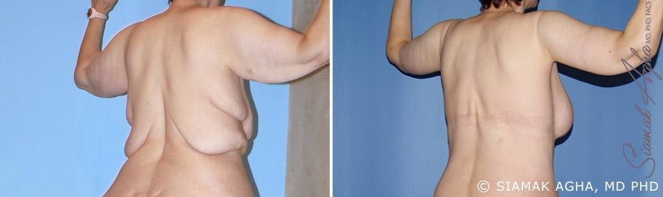 Arm Lift Before & After