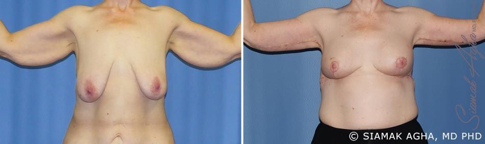 Arm Lift Before & After
