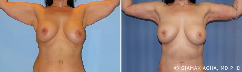 Arm Lift Before & After