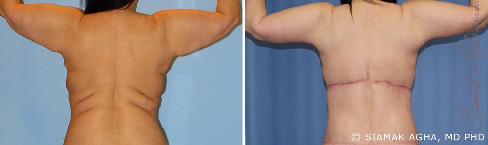 Arm Lift Before & After