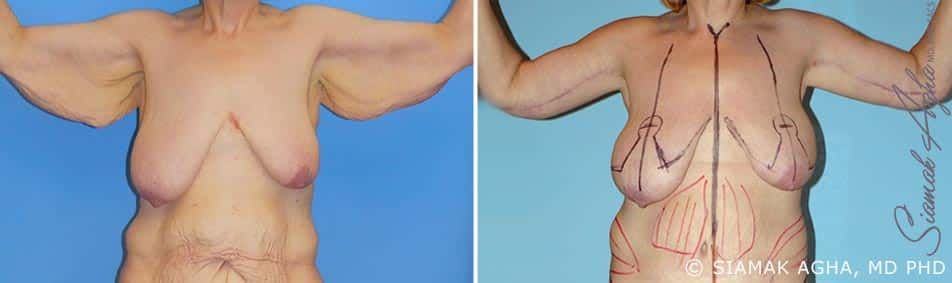 Arm Lift Before & After