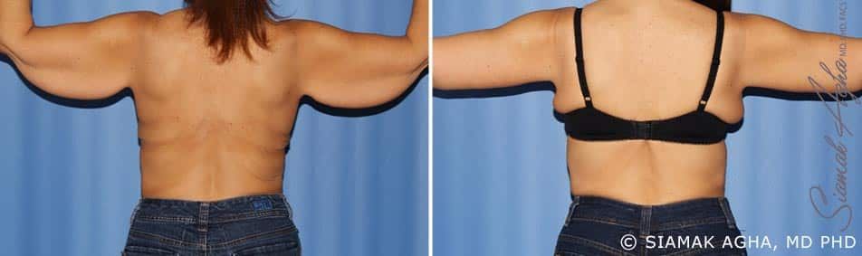 Arm Lift Before & After