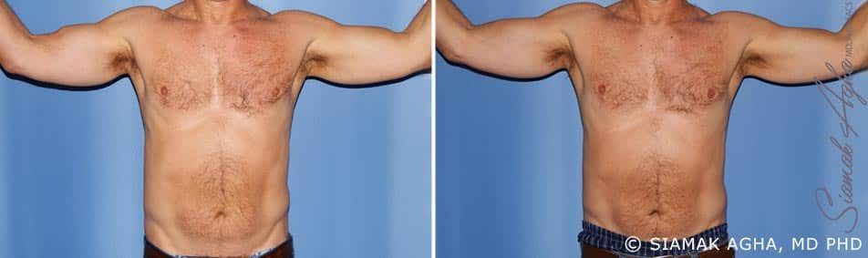 Arm Lift Before & After