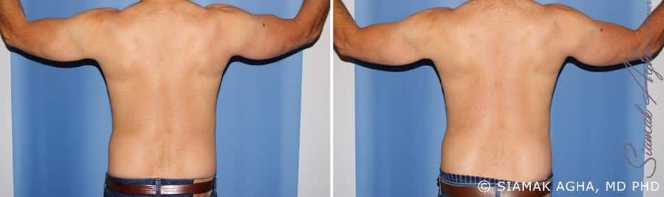 Arm Lift Before & After