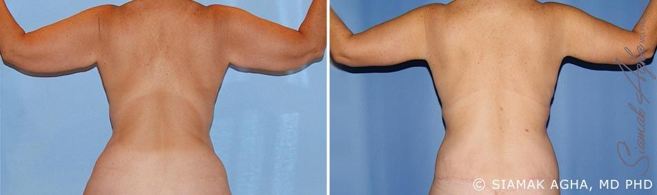 Arm Lift Before & After