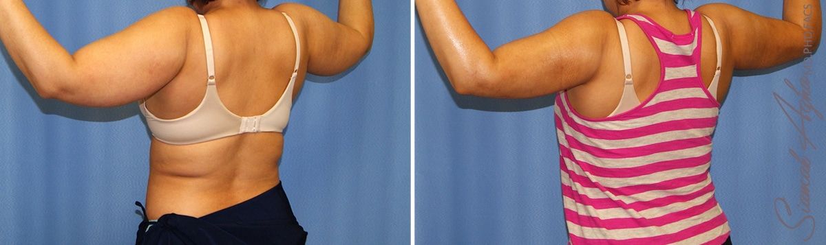 Arm Lift Before & After